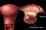 Fasting for Ovarian Cysts